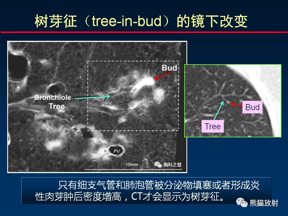 【PPT】正确判读支气管异常的CT征象
