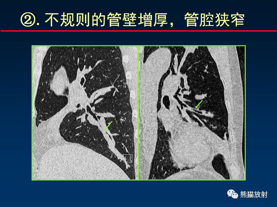 【PPT】正确判读支气管异常的CT征象