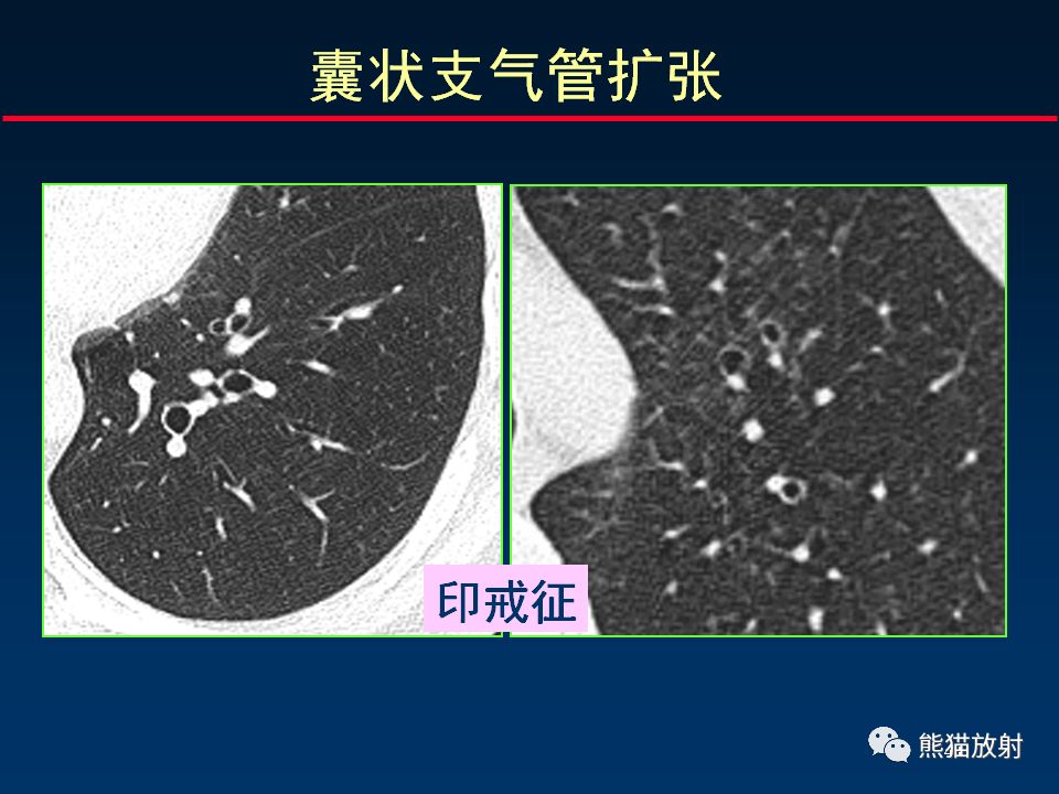 【PPT】正确判读支气管异常的CT征象