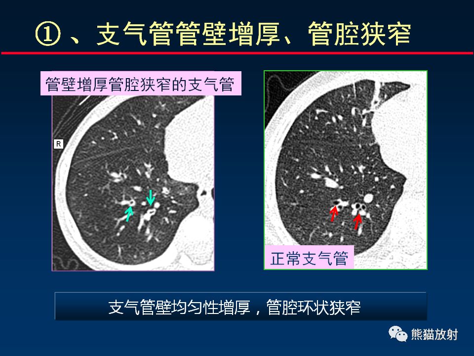 【PPT】正确判读支气管异常的CT征象