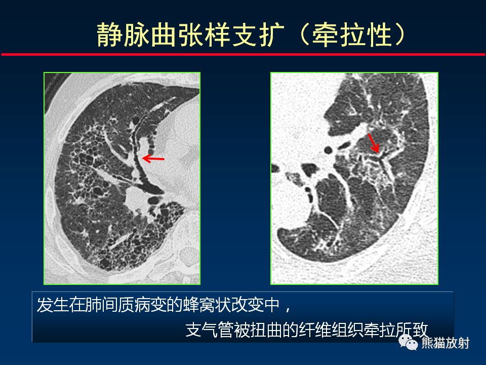 【PPT】正确判读支气管异常的CT征象
