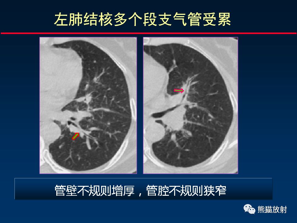 【PPT】正确判读支气管异常的CT征象