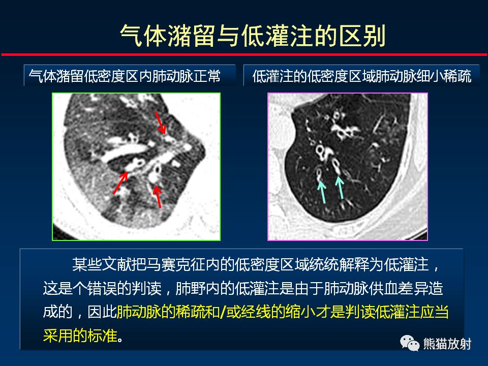 【PPT】正确判读支气管异常的CT征象