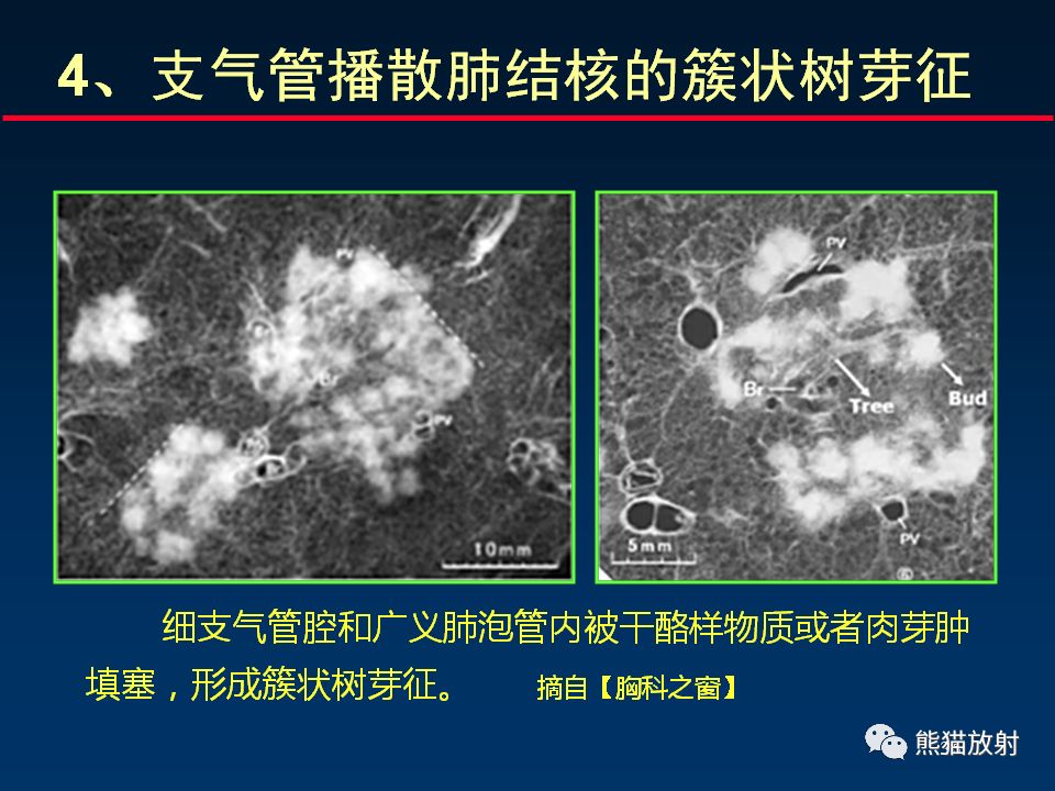 【PPT】正确判读支气管异常的CT征象