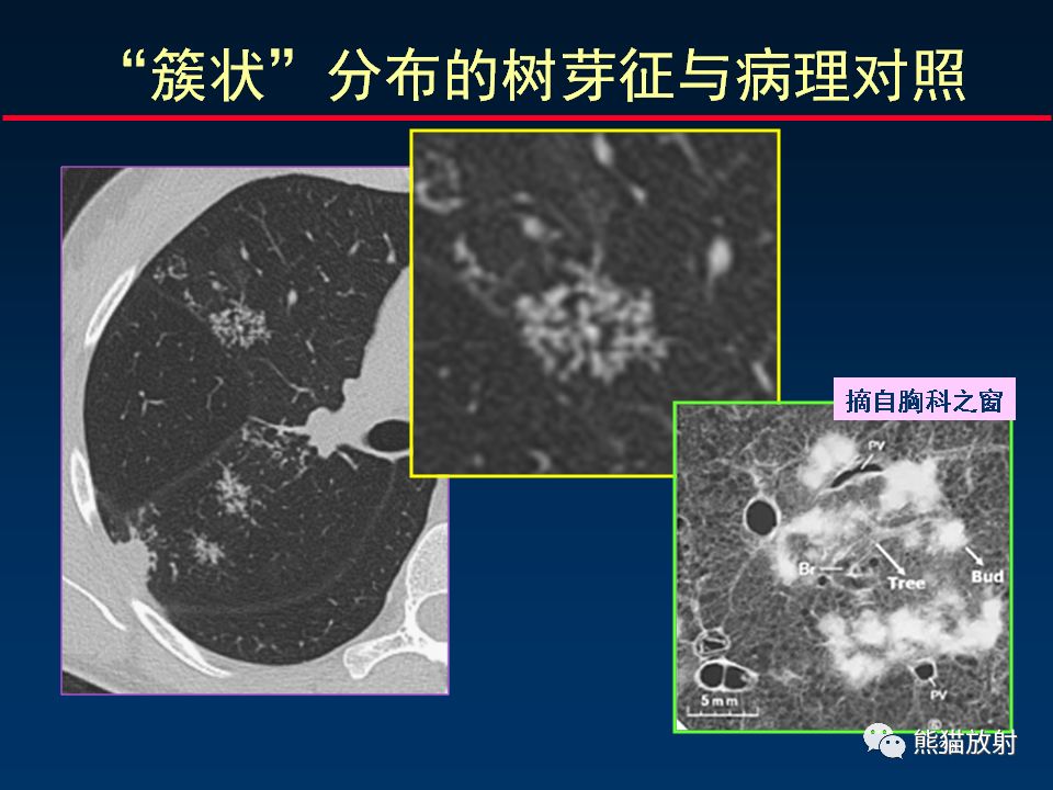 【PPT】正确判读支气管异常的CT征象