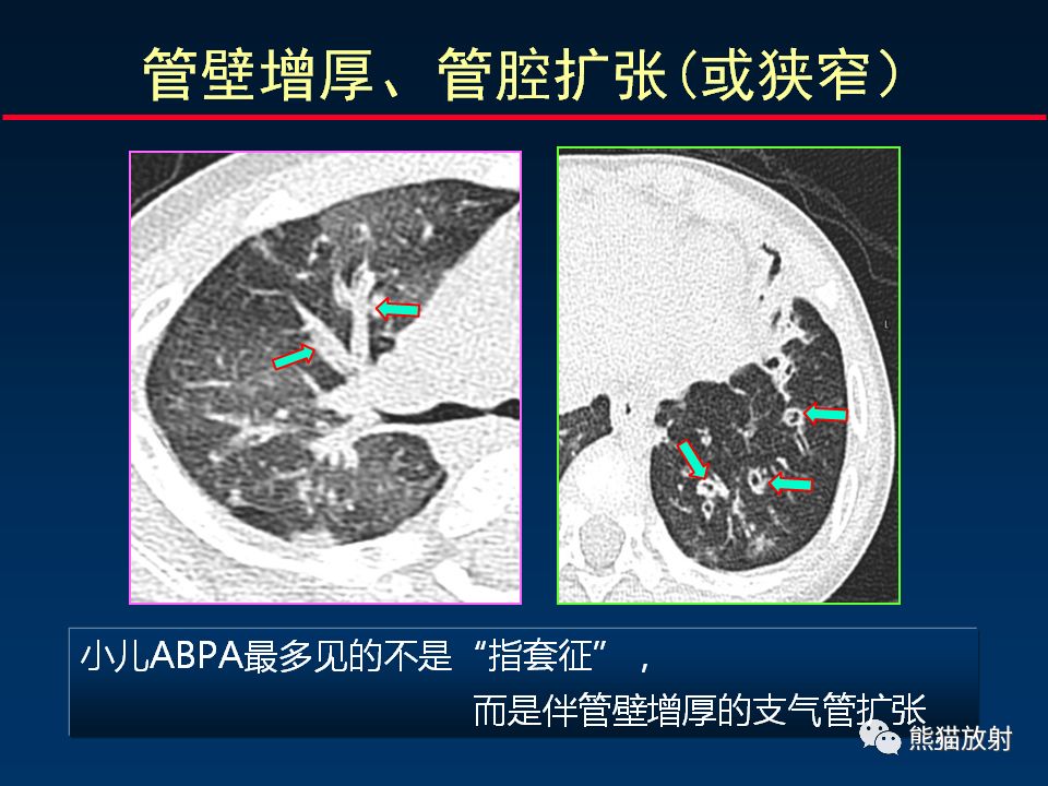 【PPT】正确判读支气管异常的CT征象