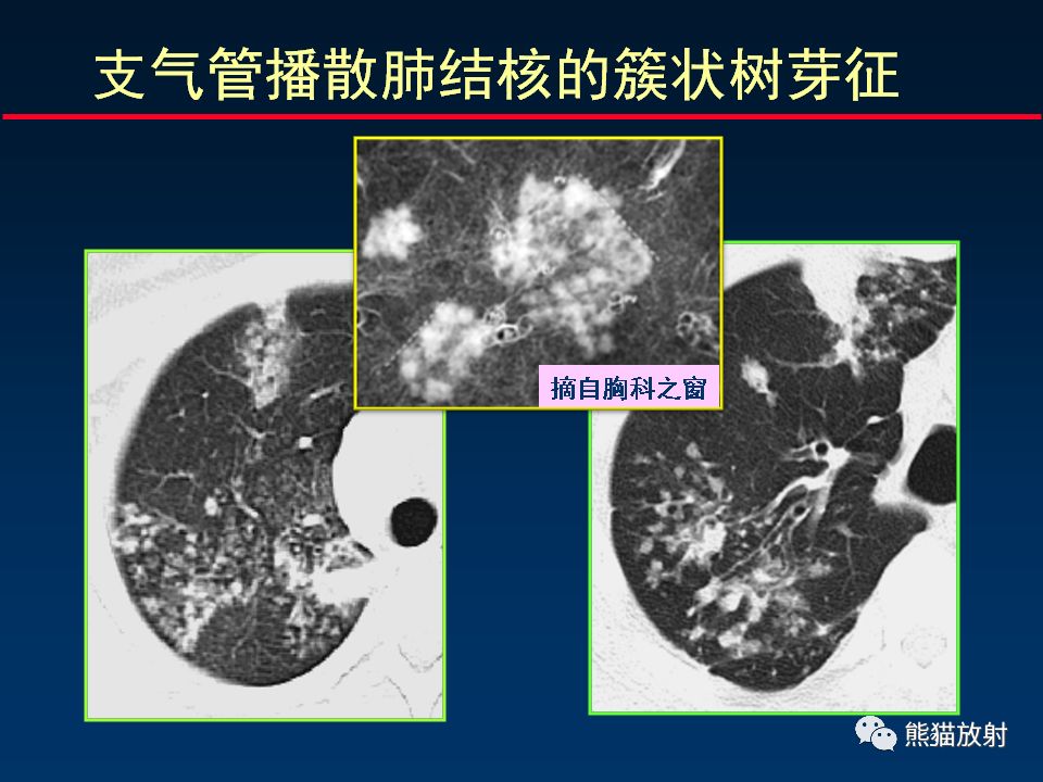 【PPT】正确判读支气管异常的CT征象