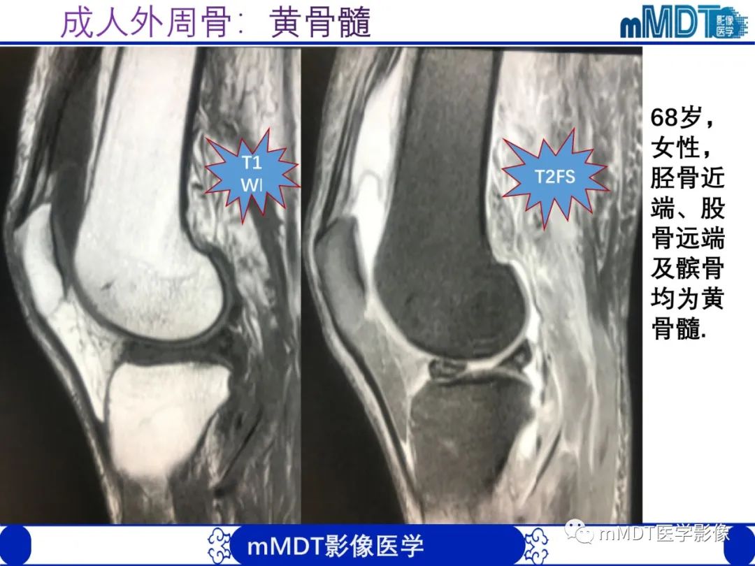 【PPT】骨髓的转化与逆转化