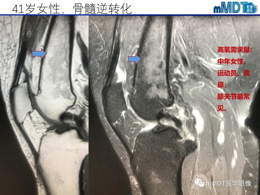 【PPT】骨髓的转化与逆转化