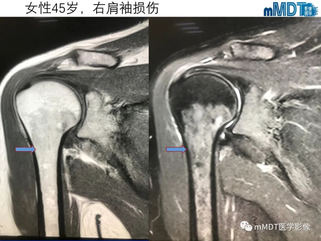【PPT】骨髓的转化与逆转化