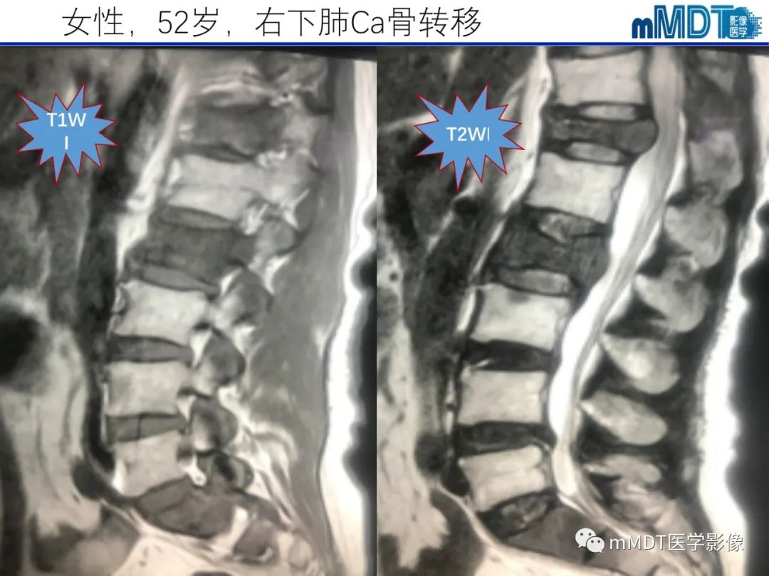 【PPT】骨髓的转化与逆转化