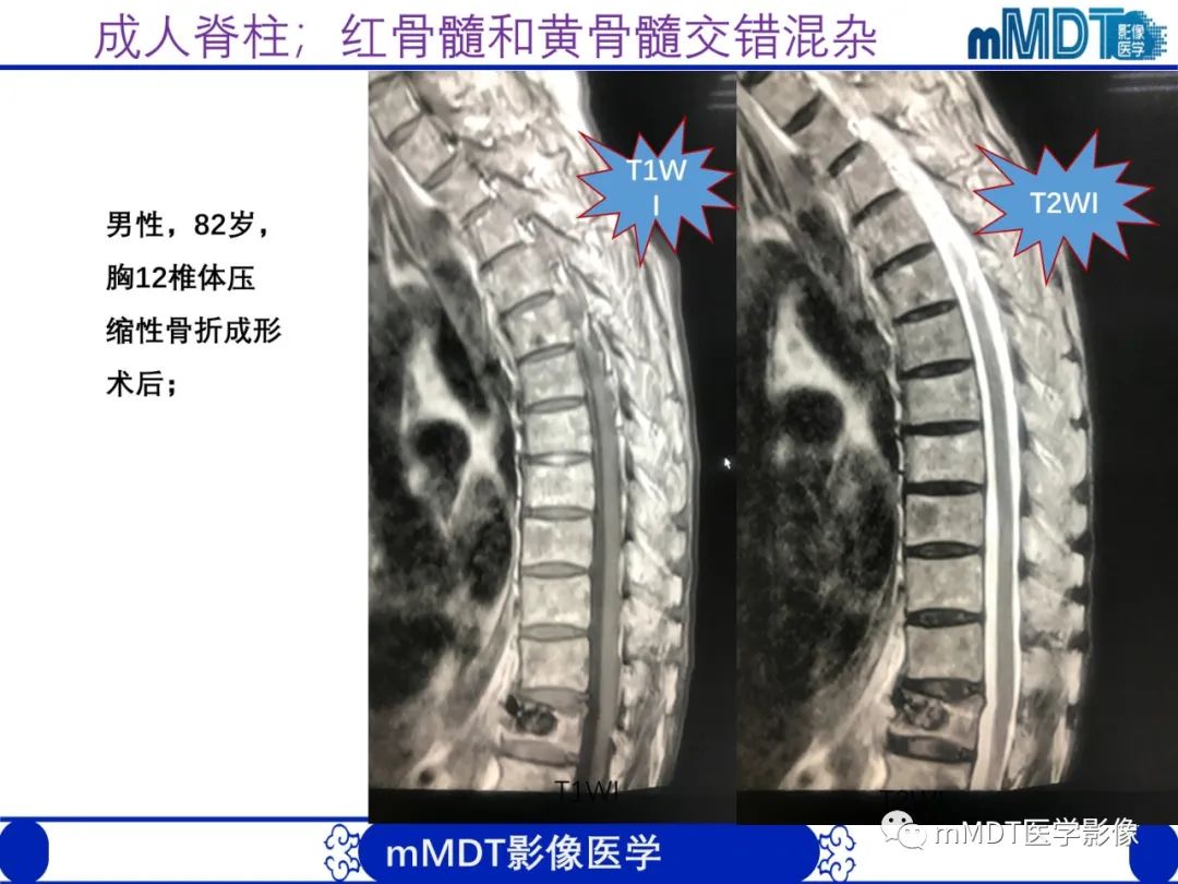【PPT】骨髓的转化与逆转化