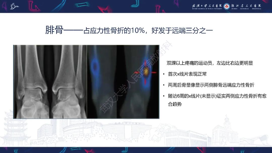 【PPT】应力性骨折影像学表现