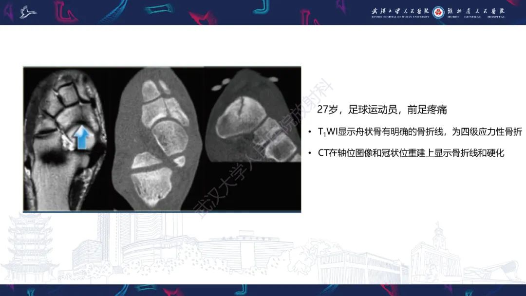 【PPT】应力性骨折影像学表现