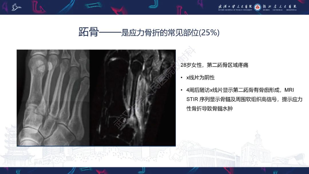 【PPT】应力性骨折影像学表现