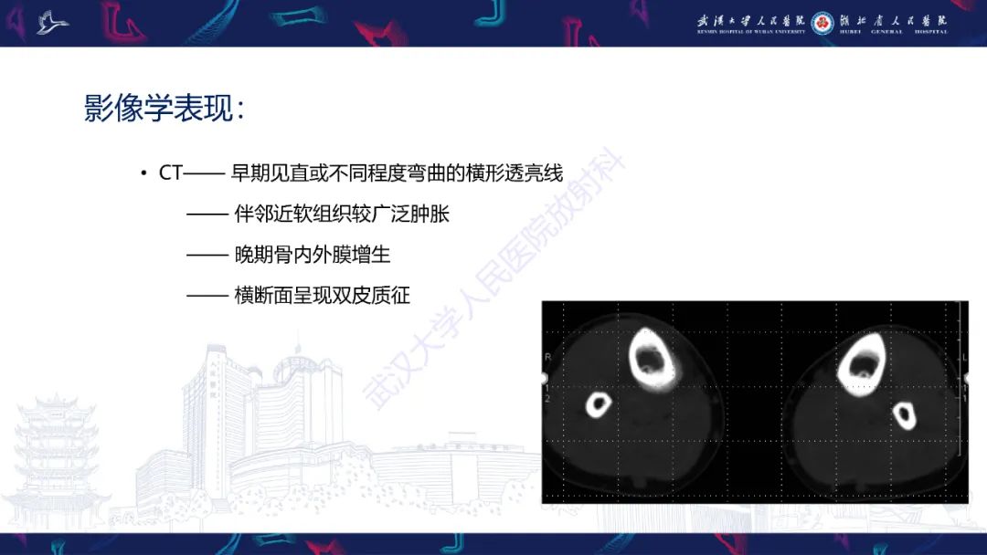 【PPT】应力性骨折影像学表现