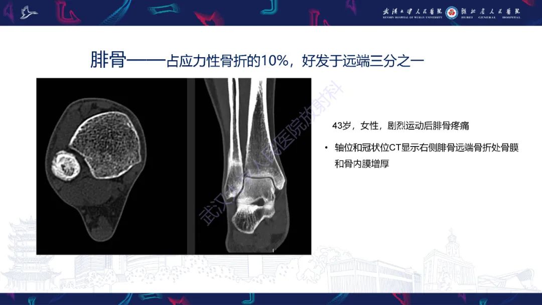【PPT】应力性骨折影像学表现