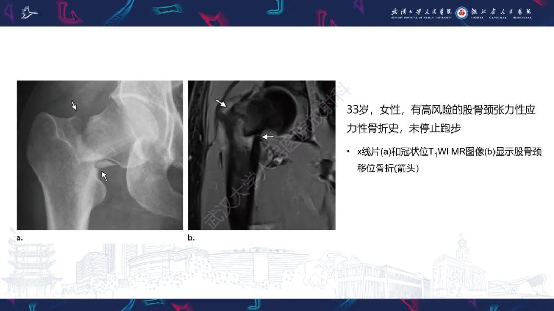 【PPT】应力性骨折影像学表现