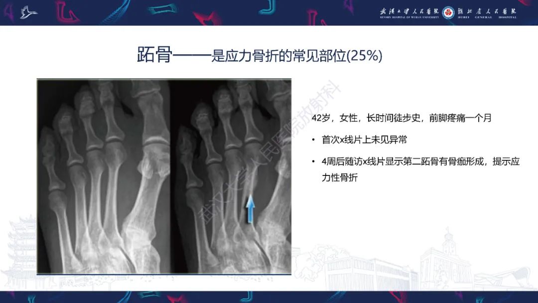 【PPT】应力性骨折影像学表现