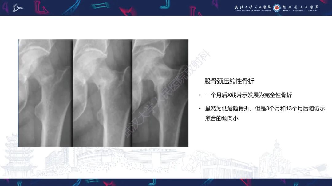 【PPT】应力性骨折影像学表现