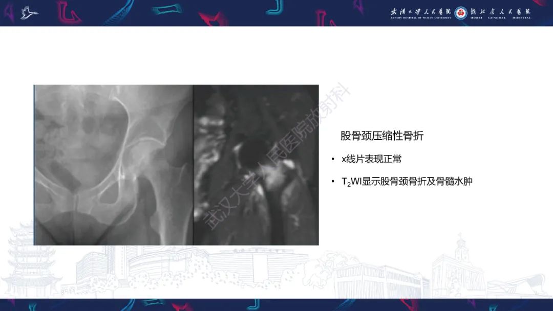 【PPT】应力性骨折影像学表现