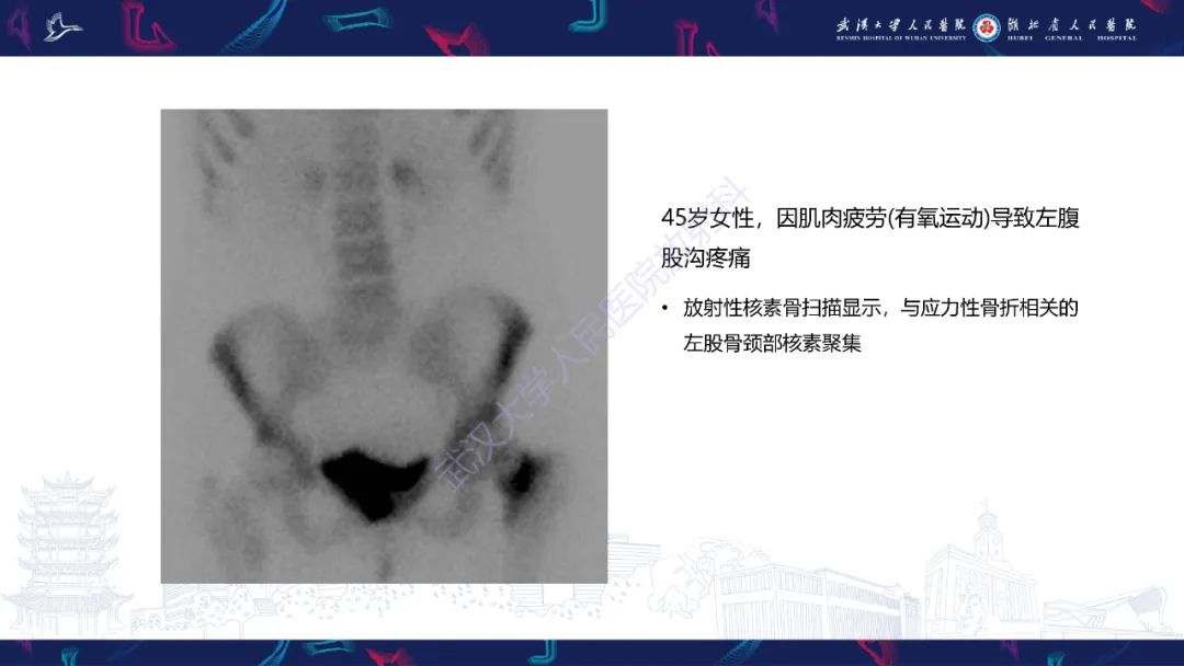 【PPT】应力性骨折影像学表现