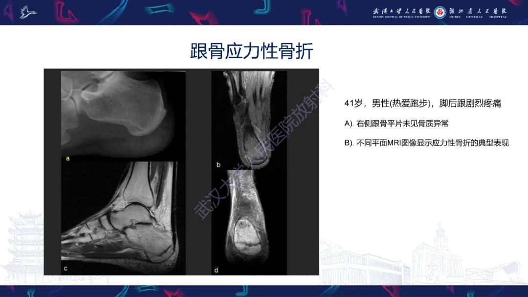 【PPT】应力性骨折影像学表现