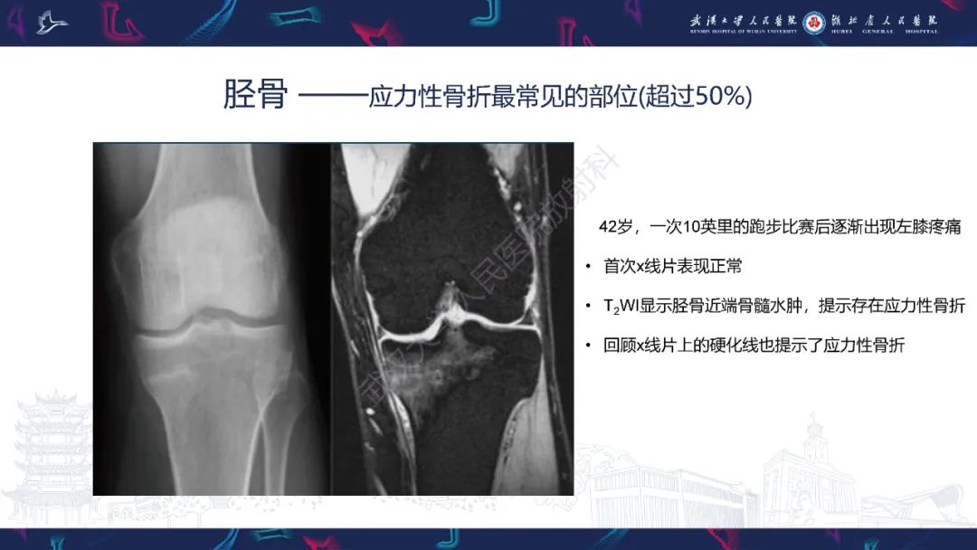 【PPT】应力性骨折影像学表现