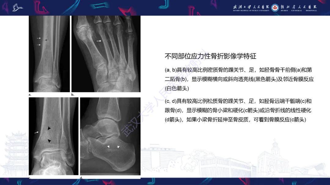 【PPT】应力性骨折影像学表现