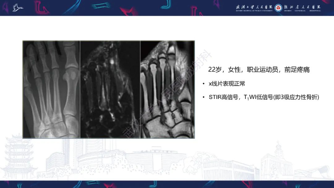 【PPT】应力性骨折影像学表现
