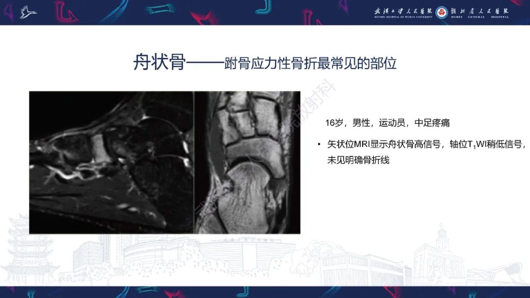 【PPT】应力性骨折影像学表现