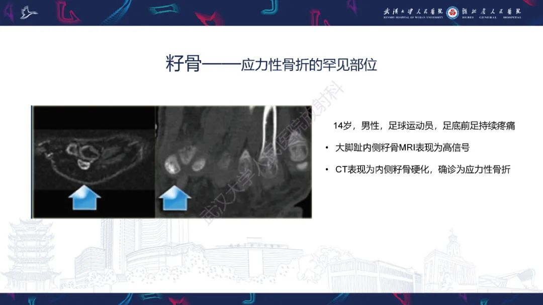 【PPT】应力性骨折影像学表现