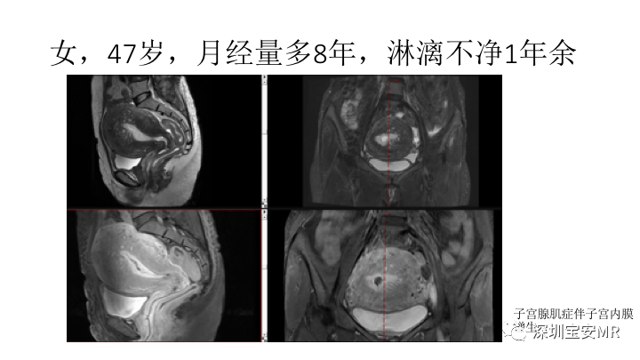 【PPT】子宫腔内病变MR