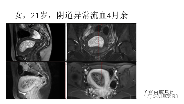 【PPT】子宫腔内病变MR