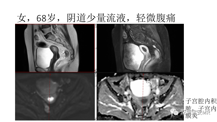 【PPT】子宫腔内病变MR