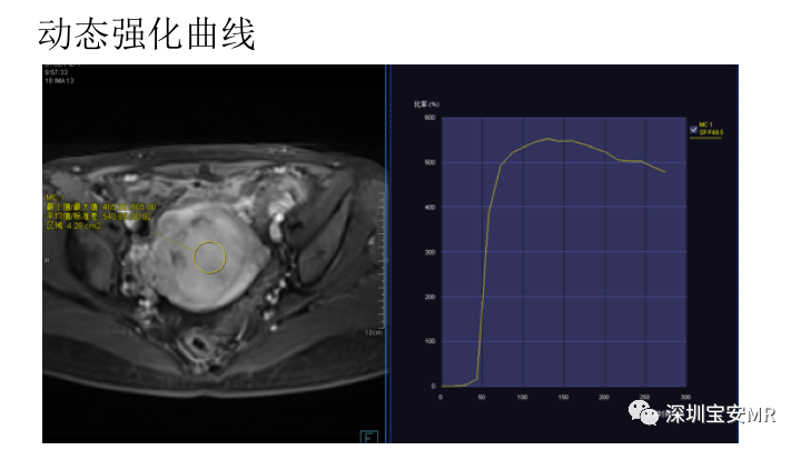 【PPT】子宫腔内病变MR