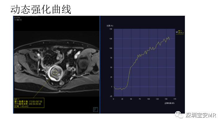 【PPT】子宫腔内病变MR