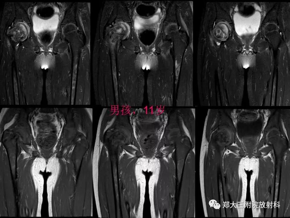【PPT】戈谢病的影像 【PPT】戈谢病的影像
