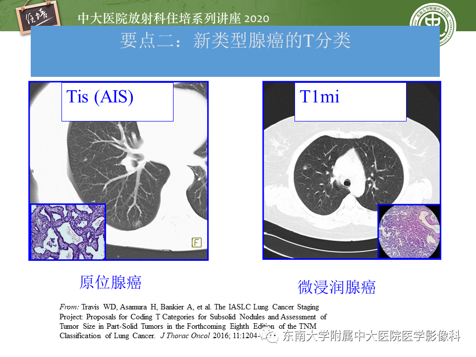 【PPT】肺癌TNM分期（UICC第8版）解读
