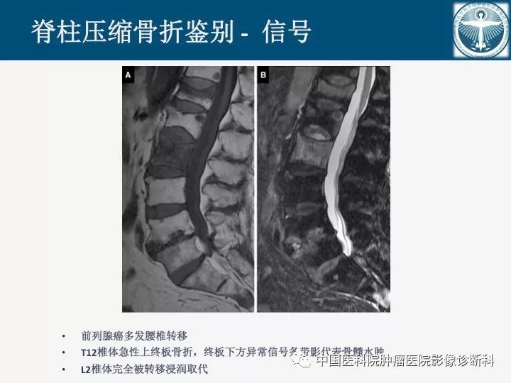 【PPT】椎体压缩骨折MRI鉴别诊断 【PPT】椎体压缩骨折MRI鉴别诊断