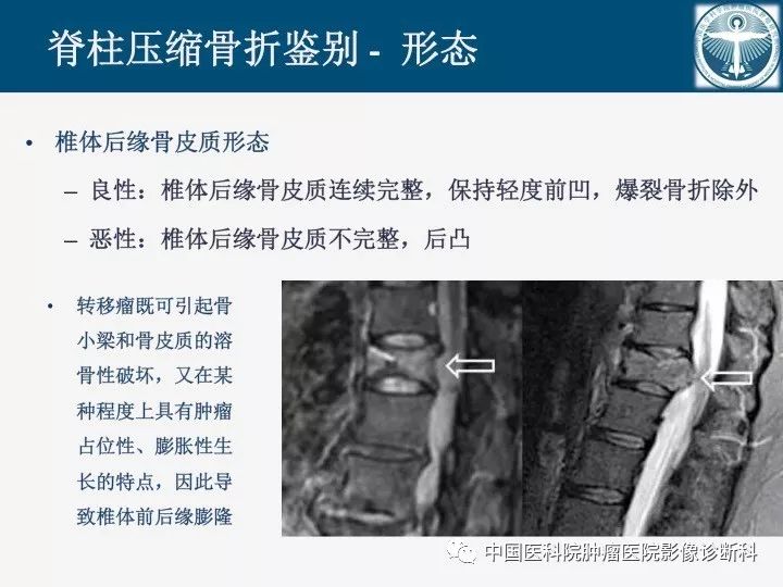 【PPT】椎体压缩骨折MRI鉴别诊断 【PPT】椎体压缩骨折MRI鉴别诊断