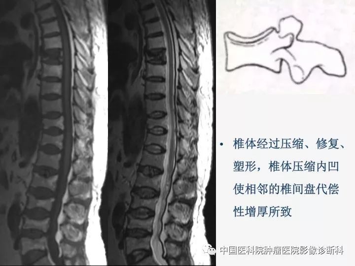 【PPT】椎体压缩骨折MRI鉴别诊断 【PPT】椎体压缩骨折MRI鉴别诊断