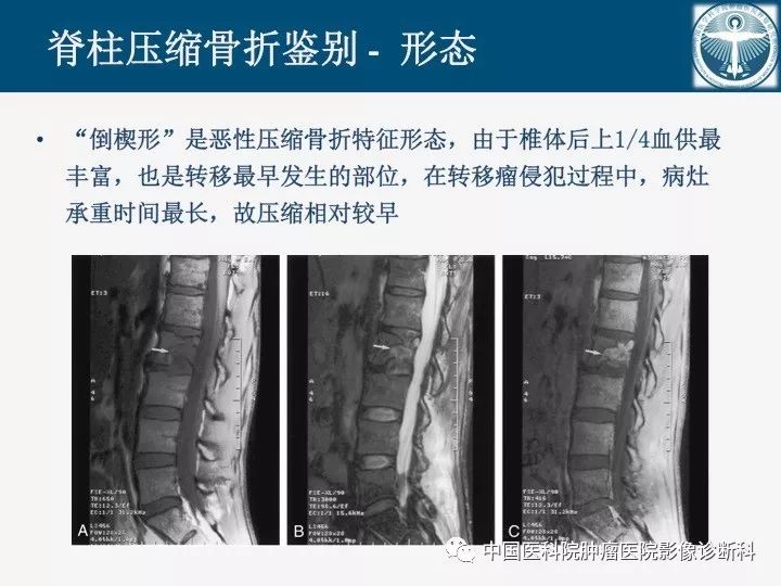 【PPT】椎体压缩骨折MRI鉴别诊断 【PPT】椎体压缩骨折MRI鉴别诊断