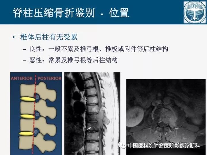 【PPT】椎体压缩骨折MRI鉴别诊断 【PPT】椎体压缩骨折MRI鉴别诊断
