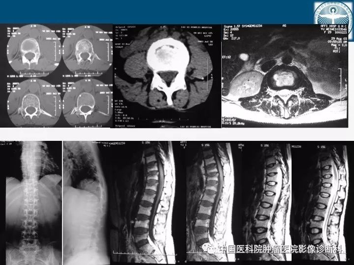 【PPT】椎体压缩骨折MRI鉴别诊断 【PPT】椎体压缩骨折MRI鉴别诊断