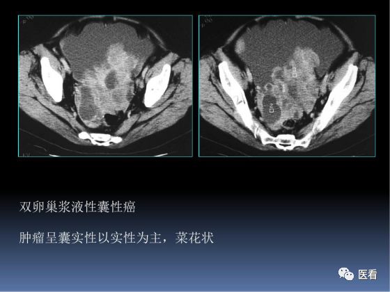【PPT】卵巢恶性肿瘤的CT诊断