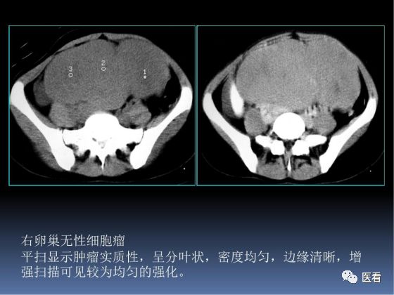 【PPT】卵巢恶性肿瘤的CT诊断