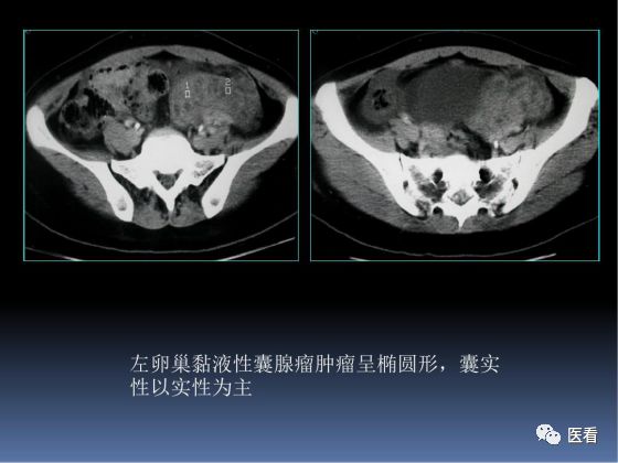 【PPT】卵巢恶性肿瘤的CT诊断