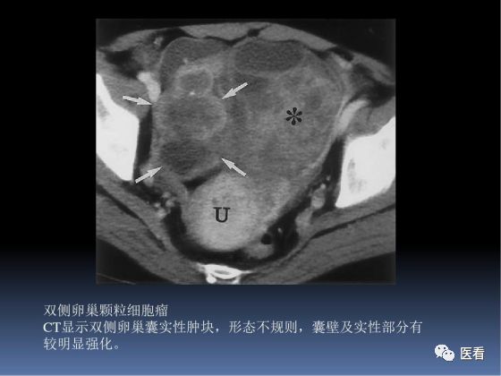 【PPT】卵巢恶性肿瘤的CT诊断