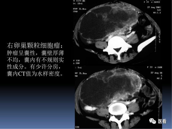 【PPT】卵巢恶性肿瘤的CT诊断